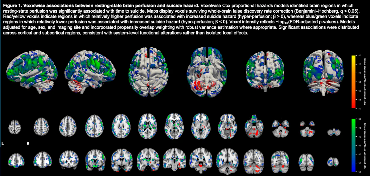 Brain SPECT offers insight into suicide risk