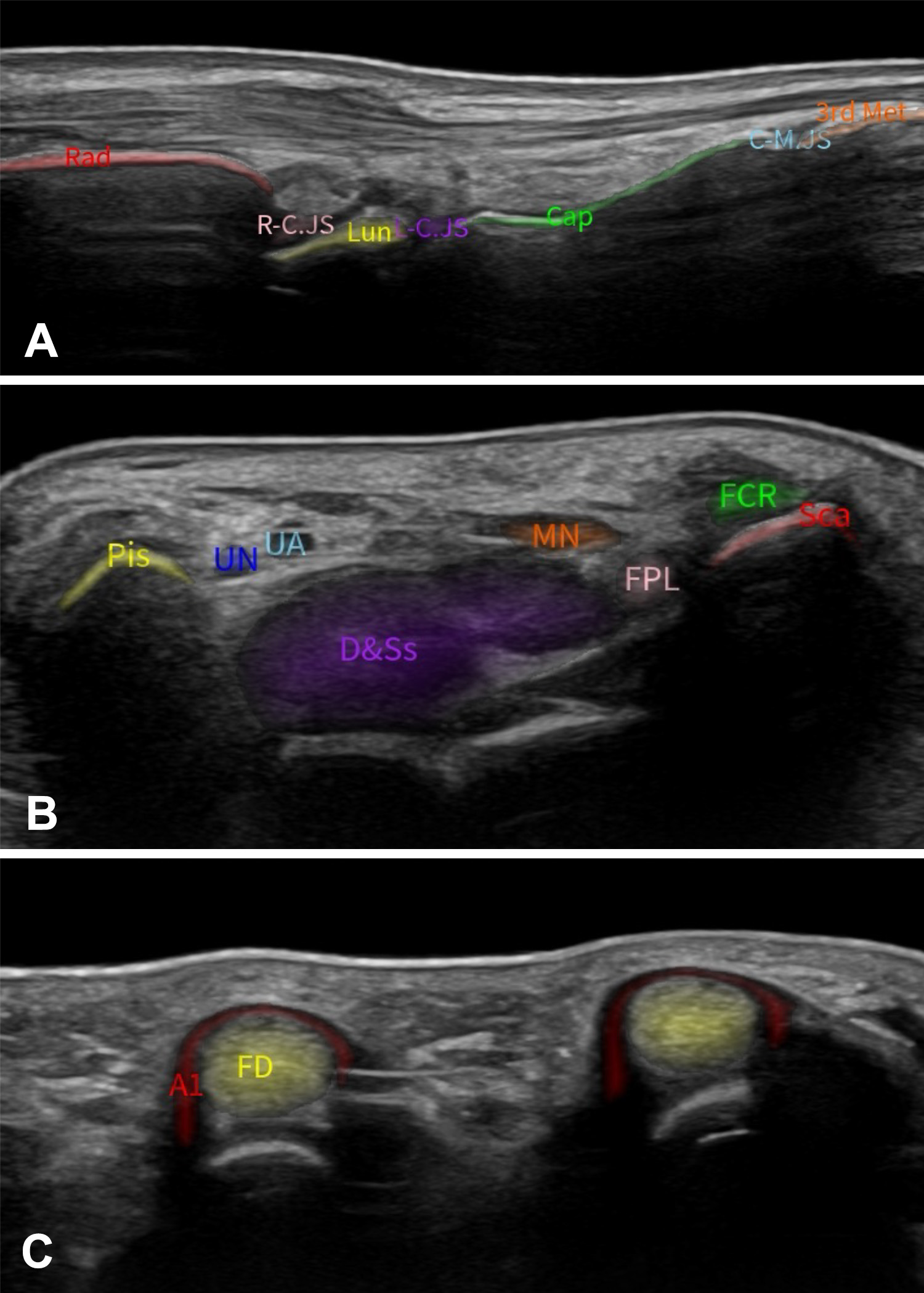 AI-acquired standardized planes. Example ultrasound images acquired in clinical settings with the on-cart, AI-based software, illustrating automated acquisition and anatomic annotation of three standard planes: (A) S5 dorsal longitudinal plane of the wrist joint, (B) S11 transverse section of the proximal carpal tunnel, and (C) S14 transverse section of the second and third flexor tendons. A1 = trochlea A1, Cap = capitate, C-M.JS = recess of the capitate-metacarpal joint, D&Ss = flexor digitorum profundus and superficialis tendons, FCR = flexor carpi radialis tendon, FD = flexor digitorum tendon, FPL = flexor pollicis longus tendon, L-C.JS = recess of the lunate-capitate joint, Lun = lunate, MN = median nerve, Pis = pisiform, Rad = radius, R-C.JS = recess of the radiocarpal joint, Sca = scaphoid, UA = ulnar artery, UN = ulnar nerve, 3rd Met = third metacarpal.
