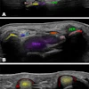 AI-acquired standardized planes. Example ultrasound images acquired in clinical settings with the on-cart, AI-based software, illustrating automated acquisition and anatomic annotation of three standard planes: (A) S5 dorsal longitudinal plane of the wrist joint, (B) S11 transverse section of the proximal carpal tunnel, and (C) S14 transverse section of the second and third flexor tendons. A1 = trochlea A1, Cap = capitate, C-M.JS = recess of the capitate-metacarpal joint, D&Ss = flexor digitorum profundus and superficialis tendons, FCR = flexor carpi radialis tendon, FD = flexor digitorum tendon, FPL = flexor pollicis longus tendon, L-C.JS = recess of the lunate-capitate joint, Lun = lunate, MN = median nerve, Pis = pisiform, Rad = radius, R-C.JS = recess of the radiocarpal joint, Sca = scaphoid, UA = ulnar artery, UN = ulnar nerve, 3rd Met = third metacarpal.