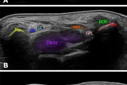 AI-acquired standardized planes. Example ultrasound images acquired in clinical settings with the on-cart, AI-based software, illustrating automated acquisition and anatomic annotation of three standard planes: (A) S5 dorsal longitudinal plane of the wrist joint, (B) S11 transverse section of the proximal carpal tunnel, and (C) S14 transverse section of the second and third flexor tendons. A1 = trochlea A1, Cap = capitate, C-M.JS = recess of the capitate-metacarpal joint, D&Ss = flexor digitorum profundus and superficialis tendons, FCR = flexor carpi radialis tendon, FD = flexor digitorum tendon, FPL = flexor pollicis longus tendon, L-C.JS = recess of the lunate-capitate joint, Lun = lunate, MN = median nerve, Pis = pisiform, Rad = radius, R-C.JS = recess of the radiocarpal joint, Sca = scaphoid, UA = ulnar artery, UN = ulnar nerve, 3rd Met = third metacarpal.
