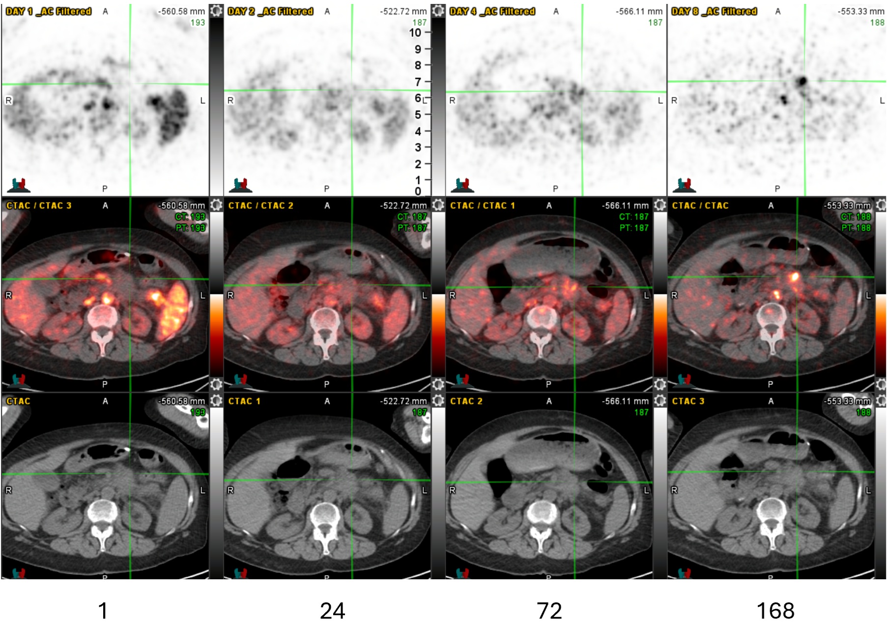 Transaxial Zr-89 NMK89 PET/CT images 1, 24, 72, and 168 hours after injection showing increasing uptake in pancreatic tail adenocarcinoma. Maximum standard uptake value (SUV) in the pancreatic mass is 14 at 168 hours post-injection (crosshairs). PET SUV scale used for windowing was 0 to 10.