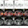 Transaxial Zr-89 NMK89 PET/CT images 1, 24, 72, and 168 hours after injection showing increasing uptake in pancreatic tail adenocarcinoma. Maximum standard uptake value (SUV) in the pancreatic mass is 14 at 168 hours post-injection (crosshairs). PET SUV scale used for windowing was 0 to 10.