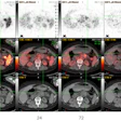 Transaxial Zr-89 NMK89 PET/CT images 1, 24, 72, and 168 hours after injection showing increasing uptake in pancreatic tail adenocarcinoma. Maximum standard uptake value (SUV) in the pancreatic mass is 14 at 168 hours post-injection (crosshairs). PET SUV scale used for windowing was 0 to 10.