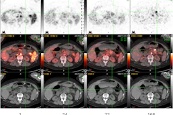 Transaxial Zr-89 NMK89 PET/CT images 1, 24, 72, and 168 hours after injection showing increasing uptake in pancreatic tail adenocarcinoma. Maximum standard uptake value (SUV) in the pancreatic mass is 14 at 168 hours post-injection (crosshairs). PET SUV scale used for windowing was 0 to 10.