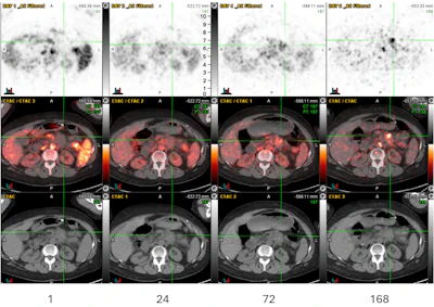 Transaxial Zr-89 NMK89 PET/CT images 1, 24, 72, and 168 hours after injection showing increasing uptake in pancreatic tail adenocarcinoma. Maximum standard uptake value (SUV) in the pancreatic mass is 14 at 168 hours post-injection (crosshairs). PET SUV scale used for windowing was 0 to 10.