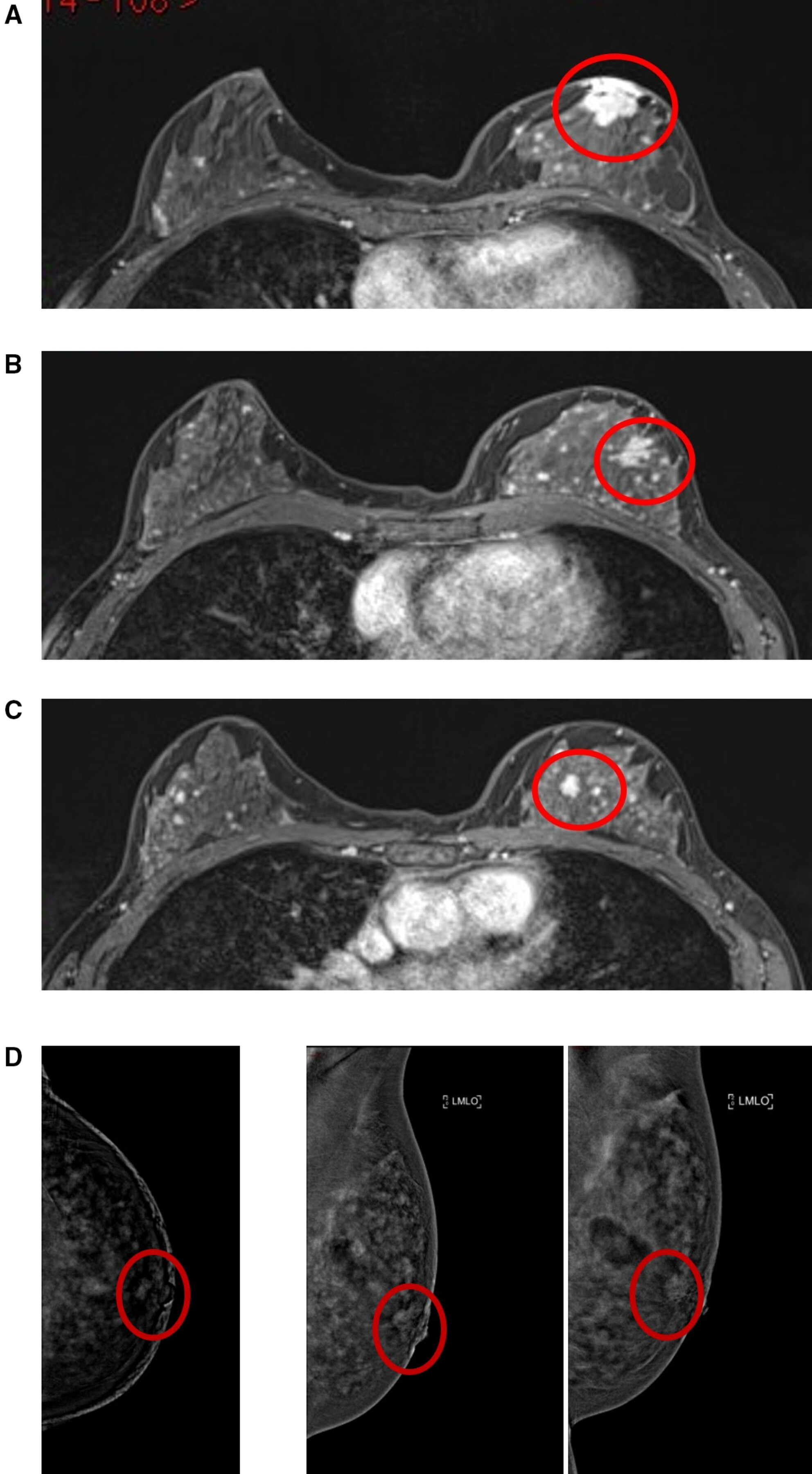 MRI false positive for additional disease, (top to bottom): A. Index lesion&mdash;grade 2 invasive ductal carcinoma; B. MRI lesion two, upper inner quadrant: Stromal sclerosis and columnar cell change; C. MRI lesion three, upper outer quadrant: No ultrasound correlate, no malignancy on follow-up; D. CEM marked background parenchymal enhancement with a unifocal retroareolar lesion demonstrating wash-out on delayed MLO. Images are republished under a Creative Commons license (CC BY 4.0).