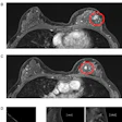 MRI false positive for additional disease, (top to bottom): A. Index lesion—grade 2 invasive ductal carcinoma; B. MRI lesion two, upper inner quadrant: Stromal sclerosis and columnar cell change; C. MRI lesion three, upper outer quadrant: No ultrasound correlate, no malignancy on follow-up; D. CEM marked background parenchymal enhancement with a unifocal retroareolar lesion demonstrating wash-out on delayed MLO. Images are republished under a Creative Commons license (CC BY 4.0).