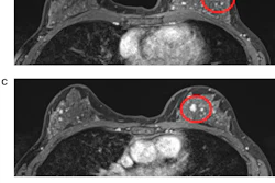 MRI false positive for additional disease, (top to bottom): A. Index lesion—grade 2 invasive ductal carcinoma; B. MRI lesion two, upper inner quadrant: Stromal sclerosis and columnar cell change; C. MRI lesion three, upper outer quadrant: No ultrasound correlate, no malignancy on follow-up; D. CEM marked background parenchymal enhancement with a unifocal retroareolar lesion demonstrating wash-out on delayed MLO. Images are republished under a Creative Commons license (CC BY 4.0).