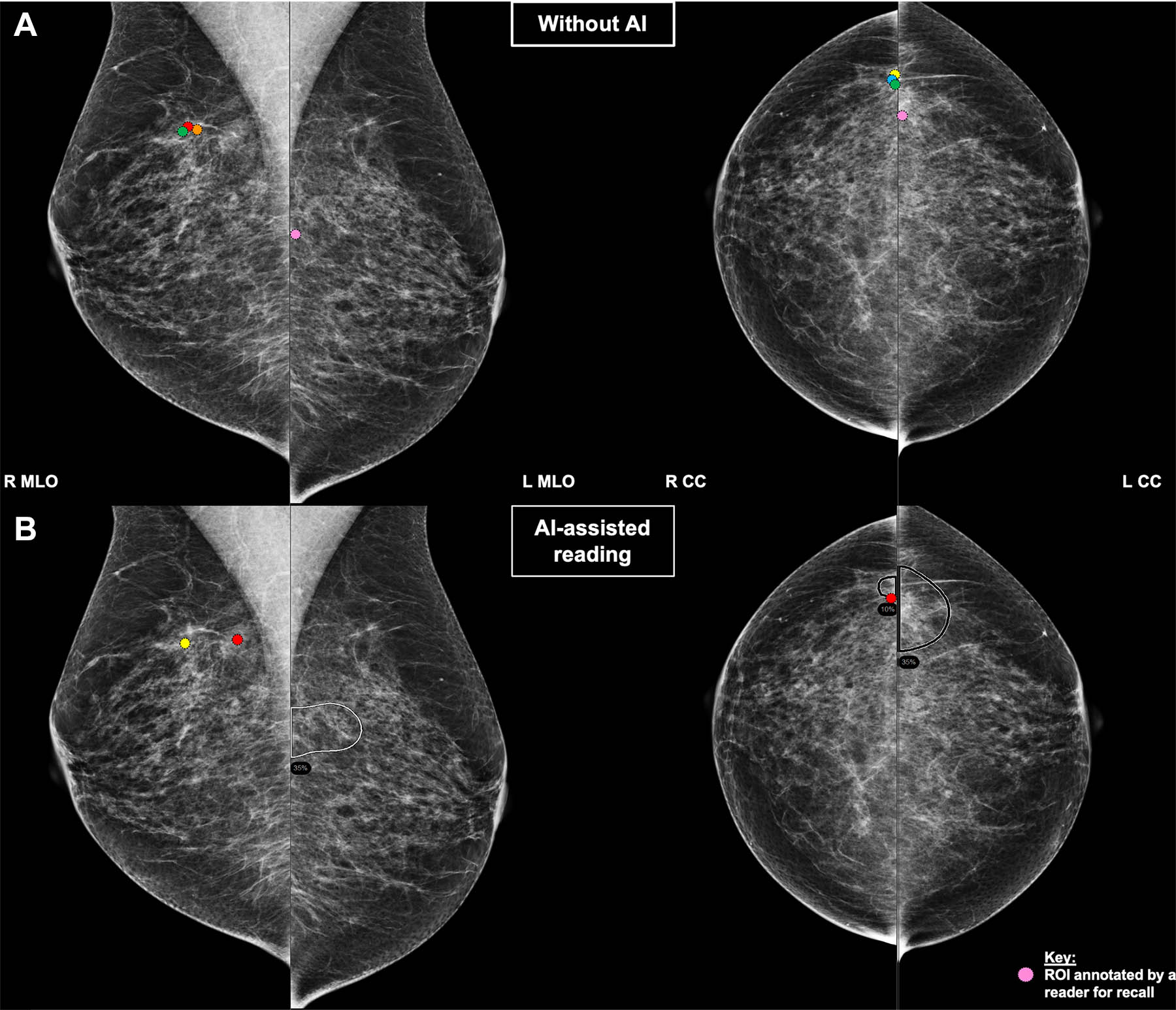 A normal mammogram confirmed by three-year radiologic follow-up illustrates reader-marked regions of interest (ROIs) during (A) unaided (round 1) and (B) artificial intelligence (AI)&ndash;assisted (round 2) reading. Each colored dot represents an ROI for recall by a human reader. Readers could mark more than one ROI per case, represented by multiple dots of the same color. During AI-assisted reading, the AI system displayed three visible prompts: two with suspicion of malignancy scores of 35% (left mediolateral oblique [L MLO] and craniocaudal [L CC]) and one with a suspicion of malignancy score of 10% (right craniocaudal [R CC]), shown as polygonal overlays. Without AI, six of 10 readers (60%) marked a false-positive ROI. With AI assistance, this fell to two of 10 (20%). R MLO = right mediolateral oblique.