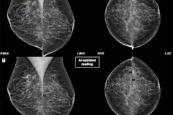 Mammography comparison showing breast cancer screening with and without AI-assisted detection markers