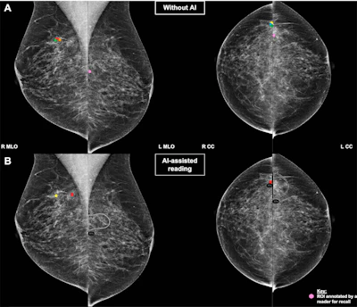 A normal mammogram confirmed by three-year radiologic follow-up illustrates reader-marked regions of interest (ROIs) during (A) unaided (round 1) and (B) artificial intelligence (AI)–assisted (round 2) reading. Each colored dot represents an ROI for recall by a human reader. Readers could mark more than one ROI per case, represented by multiple dots of the same color. During AI-assisted reading, the AI system displayed three visible prompts: two with suspicion of malignancy scores of 35% (left mediolateral oblique [L MLO] and craniocaudal [L CC]) and one with a suspicion of malignancy score of 10% (right craniocaudal [R CC]), shown as polygonal overlays. Without AI, six of 10 readers (60%) marked a false-positive ROI. With AI assistance, this fell to two of 10 (20%). R MLO = right mediolateral oblique.