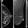 Images in a 70-year-old asymptomatic woman with a prior excisional biopsy in the left breast yielding lobular carcinoma in situ 3 years earlier. Screening contrast-enhanced mammography (CEM) was performed, which was considered a prevalence screen as the woman had no prior breast MRI in the past 3 years and no prior CEM. (A) Low-energy (26–30 kVp) mediolateral oblique (MLO) and (B) craniocaudal (CC) views show surgical clips but no abnormality. (C) Recombined MLO and (D) CC images show an enhancing mass in the medial left breast (arrows). Biopsy revealed invasive lobular carcinoma. Size was 0.2 cm; tumor grade II/III; negative lymph nodes; and estrogen receptor–positive, progesterone receptor–positive, and human epidermal growth factor receptor 2–negative.