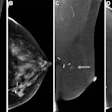 Images in a 70-year-old asymptomatic woman with a prior excisional biopsy in the left breast yielding lobular carcinoma in situ 3 years earlier. Screening contrast-enhanced mammography (CEM) was performed, which was considered a prevalence screen as the woman had no prior breast MRI in the past 3 years and no prior CEM. (A) Low-energy (26–30 kVp) mediolateral oblique (MLO) and (B) craniocaudal (CC) views show surgical clips but no abnormality. (C) Recombined MLO and (D) CC images show an enhancing mass in the medial left breast (arrows). Biopsy revealed invasive lobular carcinoma. Size was 0.2 cm; tumor grade II/III; negative lymph nodes; and estrogen receptor–positive, progesterone receptor–positive, and human epidermal growth factor receptor 2–negative.
