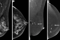 Images in a 70-year-old asymptomatic woman with a prior excisional biopsy in the left breast yielding lobular carcinoma in situ 3 years earlier. Screening contrast-enhanced mammography (CEM) was performed, which was considered a prevalence screen as the woman had no prior breast MRI in the past 3 years and no prior CEM. (A) Low-energy (26–30 kVp) mediolateral oblique (MLO) and (B) craniocaudal (CC) views show surgical clips but no abnormality. (C) Recombined MLO and (D) CC images show an enhancing mass in the medial left breast (arrows). Biopsy revealed invasive lobular carcinoma. Size was 0.2 cm; tumor grade II/III; negative lymph nodes; and estrogen receptor–positive, progesterone receptor–positive, and human epidermal growth factor receptor 2–negative.