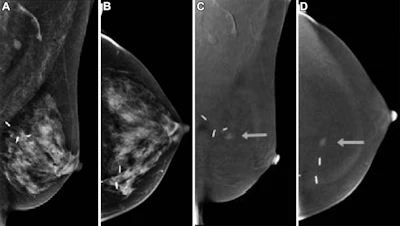 Images in a 70-year-old asymptomatic woman with a prior excisional biopsy in the left breast yielding lobular carcinoma in situ 3 years earlier. Screening contrast-enhanced mammography (CEM) was performed, which was considered a prevalence screen as the woman had no prior breast MRI in the past 3 years and no prior CEM. (A) Low-energy (26–30 kVp) mediolateral oblique (MLO) and (B) craniocaudal (CC) views show surgical clips but no abnormality. (C) Recombined MLO and (D) CC images show an enhancing mass in the medial left breast (arrows). Biopsy revealed invasive lobular carcinoma. Size was 0.2 cm; tumor grade II/III; negative lymph nodes; and estrogen receptor–positive, progesterone receptor–positive, and human epidermal growth factor receptor 2–negative.