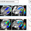 Representative cardiac MRI strain images and analysis. Images in the two-, four-, and three-chamber views for strain analysis (left) and left ventricular global longitudinal strain (GLS) and global early diastolic longitudinal strain rate (eGLSR) curves (right) are shown. (A) Example images and GLS and eGLSR curves in a 37-year-old male participant with diabetes mellitus (DM) without events during follow-up after cardiac MRI. (B) Example images and GLS and eGLSR curves in a 45-year-old male participant with DM who had heart failure hospitalization during follow-up after cardiac MRI. In the left images, blue represents higher myocardial strain (higher absolute values of negative strain), whereas red represents reduced strain. In the curves, blue represents GLS, whereas orange represents eGLSR. The left y-axis denotes GLS (%), the right y-axis represents eGLSR (per second), and the x-axis denotes time (milliseconds). For these strain parameters, a lower absolute value indicates more severe myocardial functional impairment; accordingly, GLS and eGLSR were more impaired in participants with events compared with those without events.