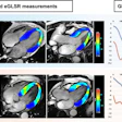 Representative cardiac MRI strain images and analysis. Images in the two-, four-, and three-chamber views for strain analysis (left) and left ventricular global longitudinal strain (GLS) and global early diastolic longitudinal strain rate (eGLSR) curves (right) are shown. (A) Example images and GLS and eGLSR curves in a 37-year-old male participant with diabetes mellitus (DM) without events during follow-up after cardiac MRI. (B) Example images and GLS and eGLSR curves in a 45-year-old male participant with DM who had heart failure hospitalization during follow-up after cardiac MRI. In the left images, blue represents higher myocardial strain (higher absolute values of negative strain), whereas red represents reduced strain. In the curves, blue represents GLS, whereas orange represents eGLSR. The left y-axis denotes GLS (%), the right y-axis represents eGLSR (per second), and the x-axis denotes time (milliseconds). For these strain parameters, a lower absolute value indicates more severe myocardial functional impairment; accordingly, GLS and eGLSR were more impaired in participants with events compared with those without events.