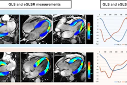Representative cardiac MRI strain images and analysis. Images in the two-, four-, and three-chamber views for strain analysis (left) and left ventricular global longitudinal strain (GLS) and global early diastolic longitudinal strain rate (eGLSR) curves (right) are shown. (A) Example images and GLS and eGLSR curves in a 37-year-old male participant with diabetes mellitus (DM) without events during follow-up after cardiac MRI. (B) Example images and GLS and eGLSR curves in a 45-year-old male participant with DM who had heart failure hospitalization during follow-up after cardiac MRI. In the left images, blue represents higher myocardial strain (higher absolute values of negative strain), whereas red represents reduced strain. In the curves, blue represents GLS, whereas orange represents eGLSR. The left y-axis denotes GLS (%), the right y-axis represents eGLSR (per second), and the x-axis denotes time (milliseconds). For these strain parameters, a lower absolute value indicates more severe myocardial functional impairment; accordingly, GLS and eGLSR were more impaired in participants with events compared with those without events.