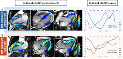 Representative cardiac MRI strain images and analysis. Images in the two-, four-, and three-chamber views for strain analysis (left) and left ventricular global longitudinal strain (GLS) and global early diastolic longitudinal strain rate (eGLSR) curves (right) are shown. (A) Example images and GLS and eGLSR curves in a 37-year-old male participant with diabetes mellitus (DM) without events during follow-up after cardiac MRI. (B) Example images and GLS and eGLSR curves in a 45-year-old male participant with DM who had heart failure hospitalization during follow-up after cardiac MRI. In the left images, blue represents higher myocardial strain (higher absolute values of negative strain), whereas red represents reduced strain. In the curves, blue represents GLS, whereas orange represents eGLSR. The left y-axis denotes GLS (%), the right y-axis represents eGLSR (per second), and the x-axis denotes time (milliseconds). For these strain parameters, a lower absolute value indicates more severe myocardial functional impairment; accordingly, GLS and eGLSR were more impaired in participants with events compared with those without events.