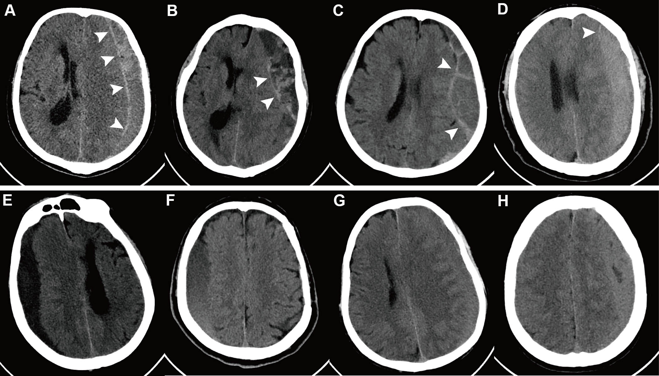 Representative axial noncontrast CT images with and without the hyperdense capsule sign (HDCS). The HDCS is defined as a hyperdense capsule layer of linear shape surrounding a subdural hematoma (SDH). (A&ndash;D) Images of SDH with the HDCS (arrowheads). (E&ndash;H) Images of SDH without the HDCS.