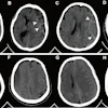 Representative axial noncontrast CT images with and without the hyperdense capsule sign (HDCS). The HDCS is defined as a hyperdense capsule layer of linear shape surrounding a subdural hematoma (SDH). (A–D) Images of SDH with the HDCS (arrowheads). (E–H) Images of SDH without the HDCS.