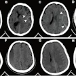Representative axial noncontrast CT images with and without the hyperdense capsule sign (HDCS). The HDCS is defined as a hyperdense capsule layer of linear shape surrounding a subdural hematoma (SDH). (A–D) Images of SDH with the HDCS (arrowheads). (E–H) Images of SDH without the HDCS.