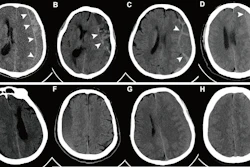 Representative axial noncontrast CT images with and without the hyperdense capsule sign (HDCS). The HDCS is defined as a hyperdense capsule layer of linear shape surrounding a subdural hematoma (SDH). (A–D) Images of SDH with the HDCS (arrowheads). (E–H) Images of SDH without the HDCS.