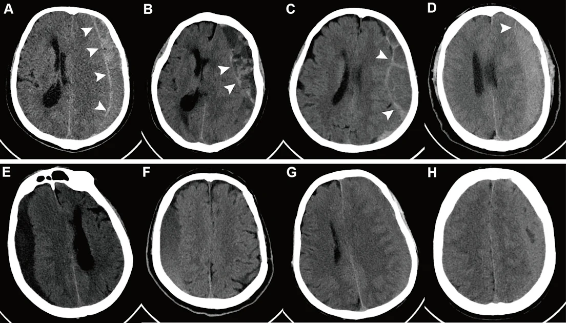 CT sign may flag who benefits subdural hematoma procedure