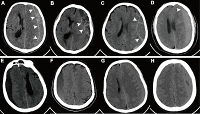 Representative axial noncontrast CT images with and without the hyperdense capsule sign (HDCS). The HDCS is defined as a hyperdense capsule layer of linear shape surrounding a subdural hematoma (SDH). (A–D) Images of SDH with the HDCS (arrowheads). (E–H) Images of SDH without the HDCS.