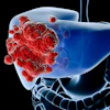 Liver Cancer