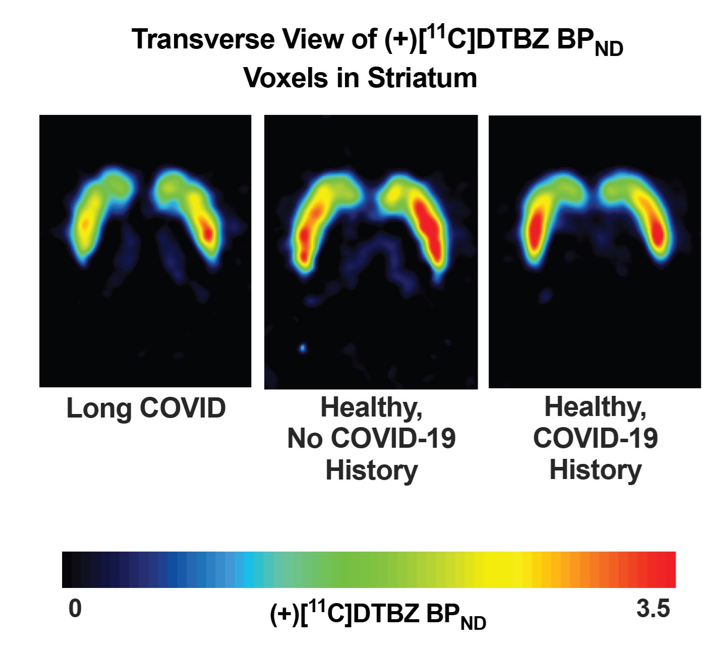 Representative participant from each group shown. C-11 DTBZ non-displaceable binding potential (BPND) in voxels quantitated with simplified reference tissue model 2. Color scale indicates C-11 DTBZ BPND from 0 (black) to 3.5 (red), with reduced C-11 DTBZ BPND observed in the long COVID case compared to both healthy controls.