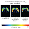 Representative participant from each group shown. C-11 DTBZ non-displaceable binding potential (BPND) in voxels quantitated with simplified reference tissue model 2. Color scale indicates C-11 DTBZ BPND from 0 (black) to 3.5 (red), with reduced C-11 DTBZ BPND observed in the long COVID case compared to both healthy controls.