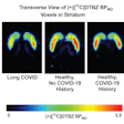 Representative participant from each group shown. C-11 DTBZ non-displaceable binding potential (BPND) in voxels quantitated with simplified reference tissue model 2. Color scale indicates C-11 DTBZ BPND from 0 (black) to 3.5 (red), with reduced C-11 DTBZ BPND observed in the long COVID case compared to both healthy controls.