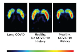 Representative participant from each group shown. C-11 DTBZ non-displaceable binding potential (BPND) in voxels quantitated with simplified reference tissue model 2. Color scale indicates C-11 DTBZ BPND from 0 (black) to 3.5 (red), with reduced C-11 DTBZ BPND observed in the long COVID case compared to both healthy controls.