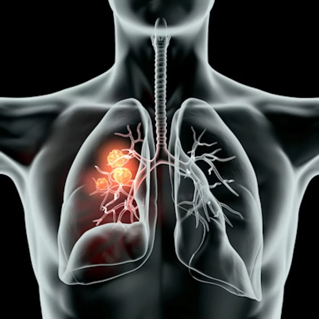 Study backs LDCT lung cancer screening in Singapore