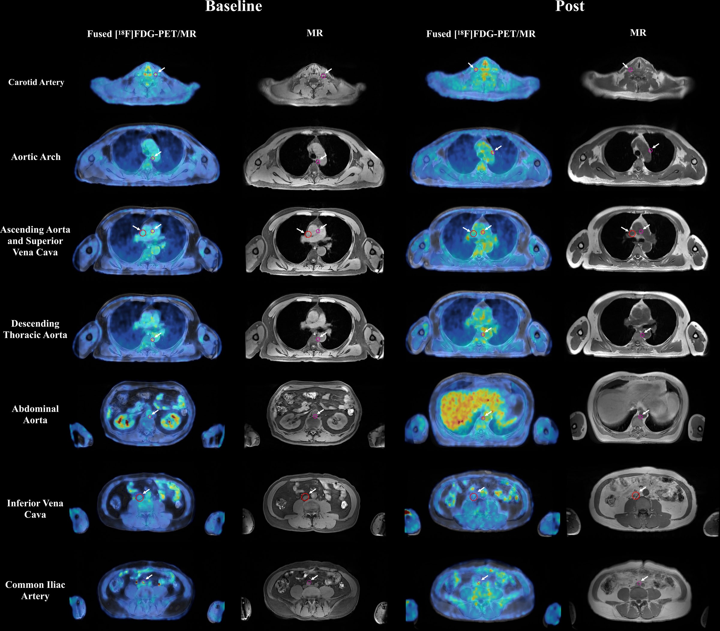 Representative axial fused F-18 FDG-PET/MRI images and corresponding anatomic MRI images from a patient imaged at baseline and after initiation of androgen deprivation therapy are shown. Each row displays a distinct vascular territory. White arrows indicate focal areas of increased tracer uptake within the arterial wall, where spherical volumes of interest (VOIs) were placed for maximum standardized uptake value (SUVmax) measurement. Additional VOIs were placed in the superior vena cava and inferior vena cava for blood-pool activity sampling. SUVmax values from the arterial VOIs were extracted on the corresponding PET images and normalized to the blood-pool mean standardized uptake value to derive the maximum target-to-background ratio.