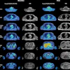Representative axial fused F-18 FDG-PET/MRI images and corresponding anatomic MRI images from a patient imaged at baseline and after initiation of androgen deprivation therapy are shown. Each row displays a distinct vascular territory. White arrows indicate focal areas of increased tracer uptake within the arterial wall, where spherical volumes of interest (VOIs) were placed for maximum standardized uptake value (SUVmax) measurement. Additional VOIs were placed in the superior vena cava and inferior vena cava for blood-pool activity sampling. SUVmax values from the arterial VOIs were extracted on the corresponding PET images and normalized to the blood-pool mean standardized uptake value to derive the maximum target-to-background ratio.