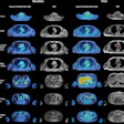Representative axial fused F-18 FDG-PET/MRI images and corresponding anatomic MRI images from a patient imaged at baseline and after initiation of androgen deprivation therapy are shown. Each row displays a distinct vascular territory. White arrows indicate focal areas of increased tracer uptake within the arterial wall, where spherical volumes of interest (VOIs) were placed for maximum standardized uptake value (SUVmax) measurement. Additional VOIs were placed in the superior vena cava and inferior vena cava for blood-pool activity sampling. SUVmax values from the arterial VOIs were extracted on the corresponding PET images and normalized to the blood-pool mean standardized uptake value to derive the maximum target-to-background ratio.