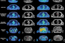 Representative axial fused F-18 FDG-PET/MRI images and corresponding anatomic MRI images from a patient imaged at baseline and after initiation of androgen deprivation therapy are shown. Each row displays a distinct vascular territory. White arrows indicate focal areas of increased tracer uptake within the arterial wall, where spherical volumes of interest (VOIs) were placed for maximum standardized uptake value (SUVmax) measurement. Additional VOIs were placed in the superior vena cava and inferior vena cava for blood-pool activity sampling. SUVmax values from the arterial VOIs were extracted on the corresponding PET images and normalized to the blood-pool mean standardized uptake value to derive the maximum target-to-background ratio.
