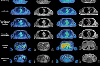 Representative axial fused F-18 FDG-PET/MRI images and corresponding anatomic MRI images from a patient imaged at baseline and after initiation of androgen deprivation therapy are shown. Each row displays a distinct vascular territory. White arrows indicate focal areas of increased tracer uptake within the arterial wall, where spherical volumes of interest (VOIs) were placed for maximum standardized uptake value (SUVmax) measurement. Additional VOIs were placed in the superior vena cava and inferior vena cava for blood-pool activity sampling. SUVmax values from the arterial VOIs were extracted on the corresponding PET images and normalized to the blood-pool mean standardized uptake value to derive the maximum target-to-background ratio.