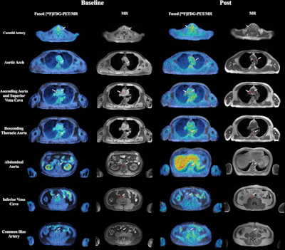 Representative axial fused F-18 FDG-PET/MRI images and corresponding anatomic MRI images from a patient imaged at baseline and after initiation of androgen deprivation therapy are shown. Each row displays a distinct vascular territory. White arrows indicate focal areas of increased tracer uptake within the arterial wall, where spherical volumes of interest (VOIs) were placed for maximum standardized uptake value (SUVmax) measurement. Additional VOIs were placed in the superior vena cava and inferior vena cava for blood-pool activity sampling. SUVmax values from the arterial VOIs were extracted on the corresponding PET images and normalized to the blood-pool mean standardized uptake value to derive the maximum target-to-background ratio.