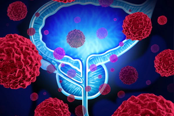 Prostate Cancer 400