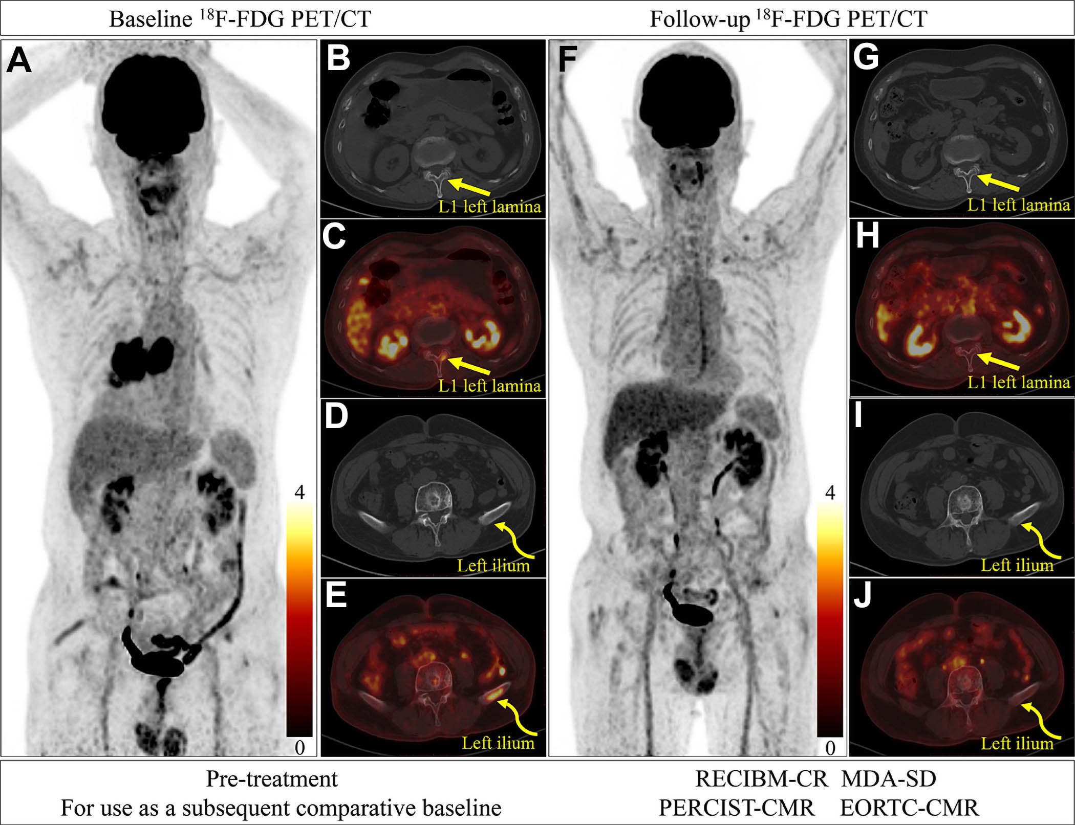 Response Evaluation Criteria in Bone Metastases (RECIBM) and metabolic criteria were used to detect a complete response missed at anatomic assessment. A 76-year-old male patient presented with 1 month of hemoptysis and was diagnosed with small cell lung cancer and bone metastases. Baseline (July 2022) F-18 FDG-PET/CT images (A, maximum intensity projection image; B&ndash;E, axial images) demonstrate FDG-avid lesions in the left lamina of the first lumbar vertebra (L1) (straight yellow arrows; maximum standardized uptake value, 2.74; peak standardized uptake value normalized to lean body mass, 1.59) and left ilium (curved yellow arrows; maximum standardized uptake value, 3.68; peak standardized uptake value normalized to lean body mass, 2.28). After seven chemotherapy cycles (December 2022), follow-up PET/CT images (F, maximum intensity projection image; G&ndash;J, axial images) show complete metabolic resolution of bony lesions (L1: maximum standardized uptake value, 1.32, and peak standardized uptake value normalized to lean body mass, 0.85; left ilium: maximum standardized uptake value, 1.48, and peak standardized uptake value normalized to lean body mass, 0.82), without apparent osteolytic or osteoblastic changes at CT. Assessment was stable disease (SD) according to the University of Texas MD Anderson Cancer Center (MDA) criteria but complete response (CR) or complete metabolic response (CMR) according to RECIBM, PET Response Criteria in Solid Tumors (PERCIST), and European Organization for Research and Treatment of Cancer (EORTC) criteria. The patient was alive as of September 30, 2025.