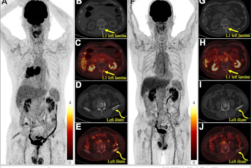 Response Evaluation Criteria in Bone Metastases (RECIBM) and metabolic criteria were used to detect a complete response missed at anatomic assessment. A 76-year-old male patient presented with 1 month of hemoptysis and was diagnosed with small cell lung cancer and bone metastases. Baseline (July 2022) F-18 FDG-PET/CT images (A, maximum intensity projection image; B–E, axial images) demonstrate FDG-avid lesions in the left lamina of the first lumbar vertebra (L1) (straight yellow arrows; maximum standardized uptake value, 2.74; peak standardized uptake value normalized to lean body mass, 1.59) and left ilium (curved yellow arrows; maximum standardized uptake value, 3.68; peak standardized uptake value normalized to lean body mass, 2.28). After seven chemotherapy cycles (December 2022), follow-up PET/CT images (F, maximum intensity projection image; G–J, axial images) show complete metabolic resolution of bony lesions (L1: maximum standardized uptake value, 1.32, and peak standardized uptake value normalized to lean body mass, 0.85; left ilium: maximum standardized uptake value, 1.48, and peak standardized uptake value normalized to lean body mass, 0.82), without apparent osteolytic or osteoblastic changes at CT. Assessment was stable disease (SD) according to the University of Texas MD Anderson Cancer Center (MDA) criteria but complete response (CR) or complete metabolic response (CMR) according to RECIBM, PET Response Criteria in Solid Tumors (PERCIST), and European Organization for Research and Treatment of Cancer (EORTC) criteria. The patient was alive as of September 30, 2025.