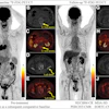 Response Evaluation Criteria in Bone Metastases (RECIBM) and metabolic criteria were used to detect a complete response missed at anatomic assessment. A 76-year-old male patient presented with 1 month of hemoptysis and was diagnosed with small cell lung cancer and bone metastases. Baseline (July 2022) F-18 FDG-PET/CT images (A, maximum intensity projection image; B–E, axial images) demonstrate FDG-avid lesions in the left lamina of the first lumbar vertebra (L1) (straight yellow arrows; maximum standardized uptake value, 2.74; peak standardized uptake value normalized to lean body mass, 1.59) and left ilium (curved yellow arrows; maximum standardized uptake value, 3.68; peak standardized uptake value normalized to lean body mass, 2.28). After seven chemotherapy cycles (December 2022), follow-up PET/CT images (F, maximum intensity projection image; G–J, axial images) show complete metabolic resolution of bony lesions (L1: maximum standardized uptake value, 1.32, and peak standardized uptake value normalized to lean body mass, 0.85; left ilium: maximum standardized uptake value, 1.48, and peak standardized uptake value normalized to lean body mass, 0.82), without apparent osteolytic or osteoblastic changes at CT. Assessment was stable disease (SD) according to the University of Texas MD Anderson Cancer Center (MDA) criteria but complete response (CR) or complete metabolic response (CMR) according to RECIBM, PET Response Criteria in Solid Tumors (PERCIST), and European Organization for Research and Treatment of Cancer (EORTC) criteria. The patient was alive as of September 30, 2025.