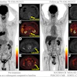 Response Evaluation Criteria in Bone Metastases (RECIBM) and metabolic criteria were used to detect a complete response missed at anatomic assessment. A 76-year-old male patient presented with 1 month of hemoptysis and was diagnosed with small cell lung cancer and bone metastases. Baseline (July 2022) F-18 FDG-PET/CT images (A, maximum intensity projection image; B–E, axial images) demonstrate FDG-avid lesions in the left lamina of the first lumbar vertebra (L1) (straight yellow arrows; maximum standardized uptake value, 2.74; peak standardized uptake value normalized to lean body mass, 1.59) and left ilium (curved yellow arrows; maximum standardized uptake value, 3.68; peak standardized uptake value normalized to lean body mass, 2.28). After seven chemotherapy cycles (December 2022), follow-up PET/CT images (F, maximum intensity projection image; G–J, axial images) show complete metabolic resolution of bony lesions (L1: maximum standardized uptake value, 1.32, and peak standardized uptake value normalized to lean body mass, 0.85; left ilium: maximum standardized uptake value, 1.48, and peak standardized uptake value normalized to lean body mass, 0.82), without apparent osteolytic or osteoblastic changes at CT. Assessment was stable disease (SD) according to the University of Texas MD Anderson Cancer Center (MDA) criteria but complete response (CR) or complete metabolic response (CMR) according to RECIBM, PET Response Criteria in Solid Tumors (PERCIST), and European Organization for Research and Treatment of Cancer (EORTC) criteria. The patient was alive as of September 30, 2025.