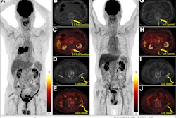 Response Evaluation Criteria in Bone Metastases (RECIBM) and metabolic criteria were used to detect a complete response missed at anatomic assessment. A 76-year-old male patient presented with 1 month of hemoptysis and was diagnosed with small cell lung cancer and bone metastases. Baseline (July 2022) F-18 FDG-PET/CT images (A, maximum intensity projection image; B–E, axial images) demonstrate FDG-avid lesions in the left lamina of the first lumbar vertebra (L1) (straight yellow arrows; maximum standardized uptake value, 2.74; peak standardized uptake value normalized to lean body mass, 1.59) and left ilium (curved yellow arrows; maximum standardized uptake value, 3.68; peak standardized uptake value normalized to lean body mass, 2.28). After seven chemotherapy cycles (December 2022), follow-up PET/CT images (F, maximum intensity projection image; G–J, axial images) show complete metabolic resolution of bony lesions (L1: maximum standardized uptake value, 1.32, and peak standardized uptake value normalized to lean body mass, 0.85; left ilium: maximum standardized uptake value, 1.48, and peak standardized uptake value normalized to lean body mass, 0.82), without apparent osteolytic or osteoblastic changes at CT. Assessment was stable disease (SD) according to the University of Texas MD Anderson Cancer Center (MDA) criteria but complete response (CR) or complete metabolic response (CMR) according to RECIBM, PET Response Criteria in Solid Tumors (PERCIST), and European Organization for Research and Treatment of Cancer (EORTC) criteria. The patient was alive as of September 30, 2025.
