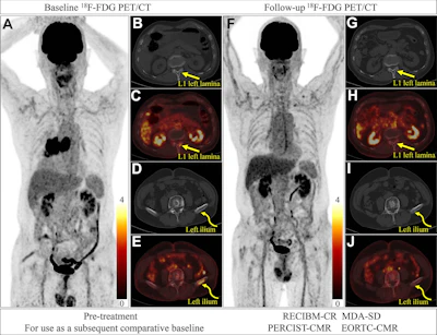 New criteria evaluates treatment response in bone metastases
