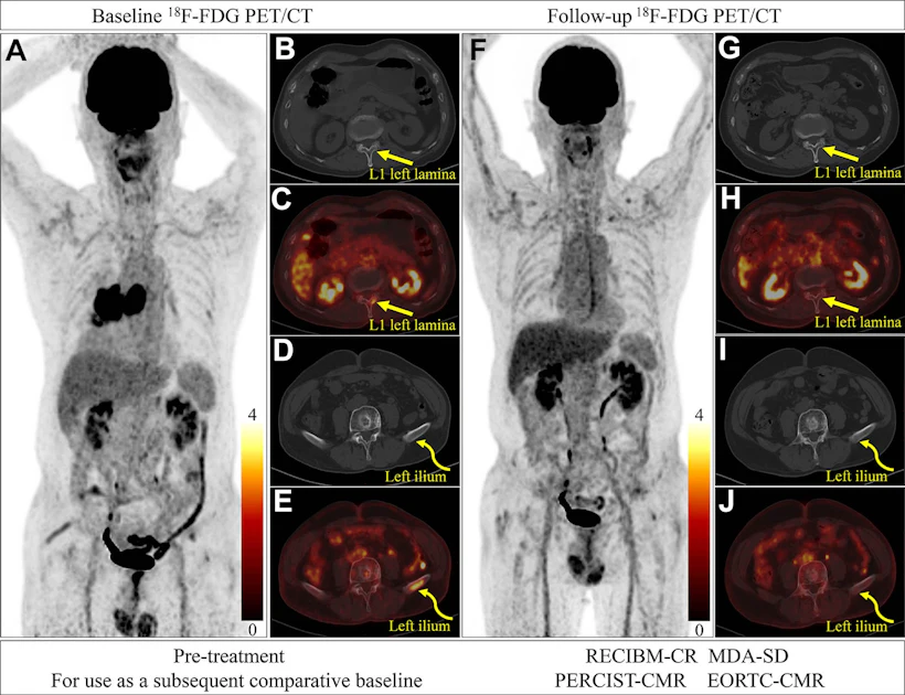 New criteria evaluates treatment response in bone metastases