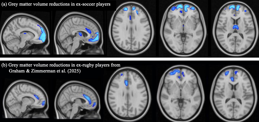 Voxel-based morphometry (VBM) group comparison of grey matter brain volumes. TFCE-corrected significance map shown (one-tailed t-test; higher significance indicated by light blue color). (a) Comparison between ex-soccer players (n = 124) and controls (n = 40). (b) Comparison between ex-rugby players (n = 200) and controls (n = 33) from Graham & Zimmerman et al. (2025), reproduced with permission under Creative Commons license.